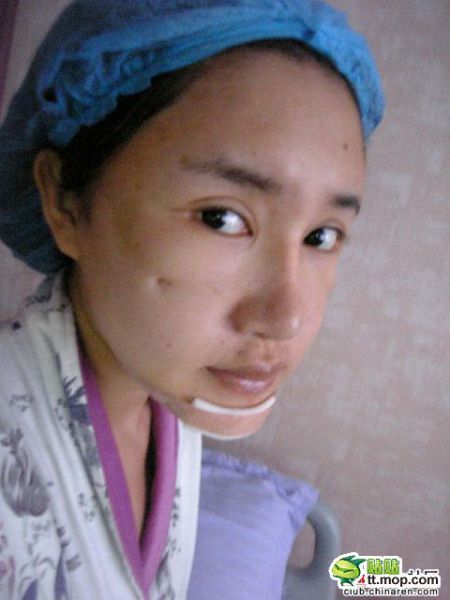Девушка из Китая до и после пластической операции (13 фото)