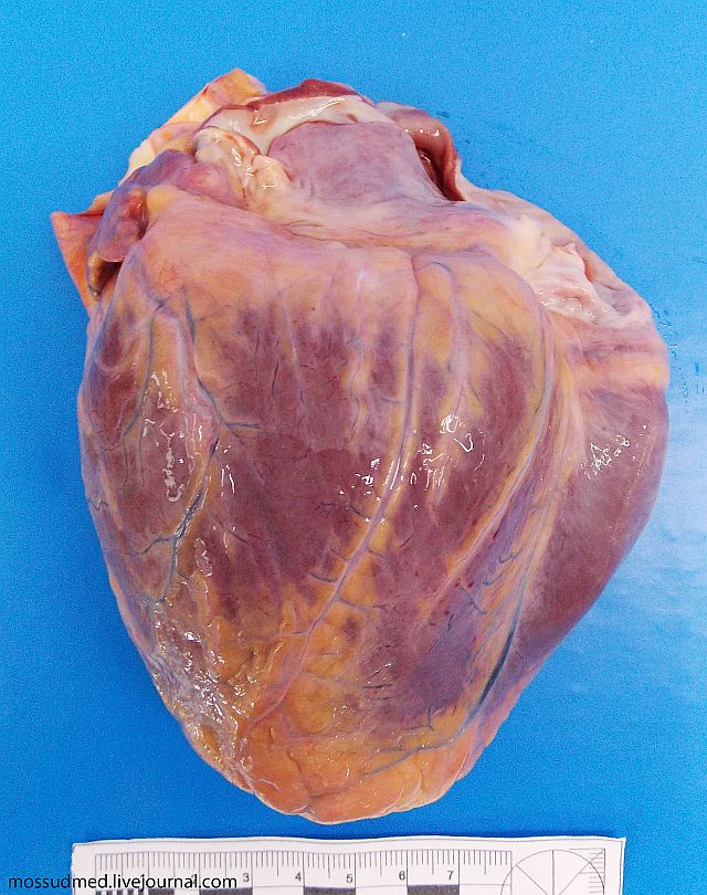 Сердце Человека С Лишним Весом