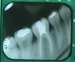 Стоматолог, зубы, боль. Что может быть хуже!?