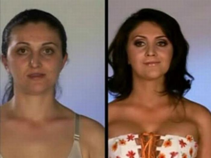 Гигантомастия фото у девочек до и после операции
