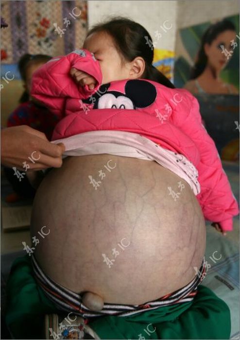Маленькая девочка с огромным животом (19 фото)