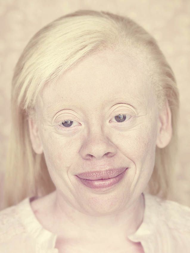 Почему у альбиносов косые глаза